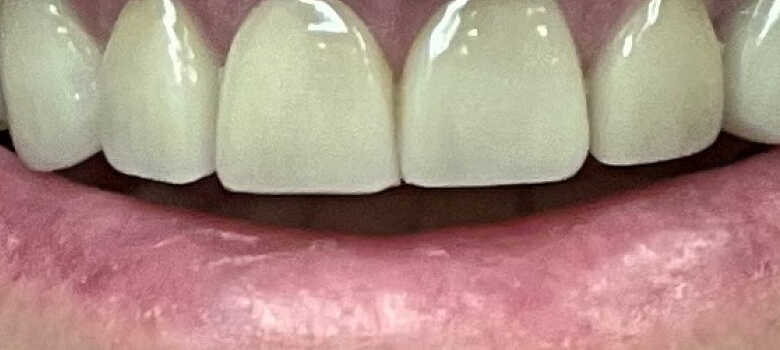 after dental veneers by dentist