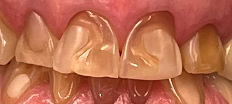before dental veneers by dentist