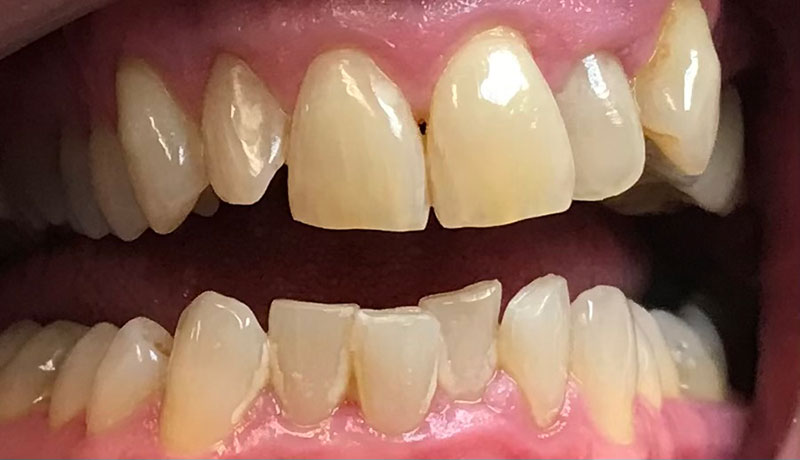 before teeth whitening by dentist